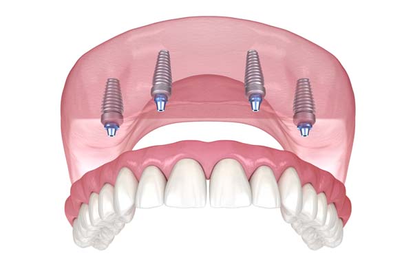 What Is All-on-4® and How Can It Replace Missing Teeth?