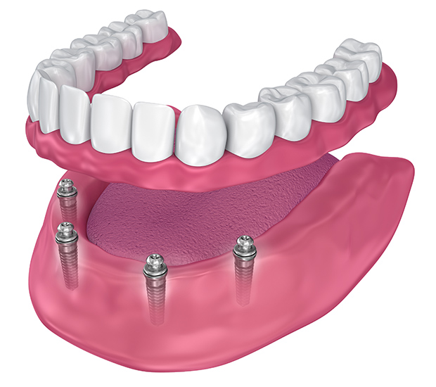 all-on-4-dental-implants