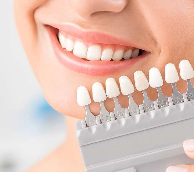 dental-veneers-and-dental-laminates