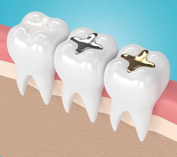 West Bloomfield Township Composite Fillings
