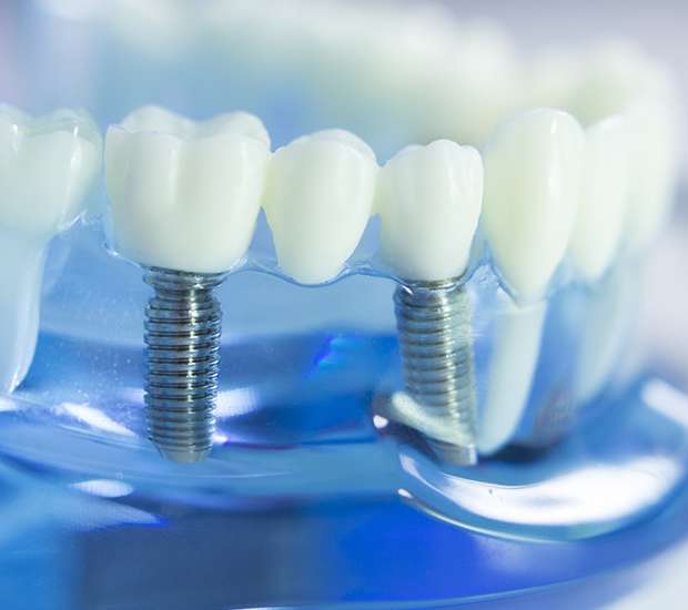 West Bloomfield Township Dental Implants
