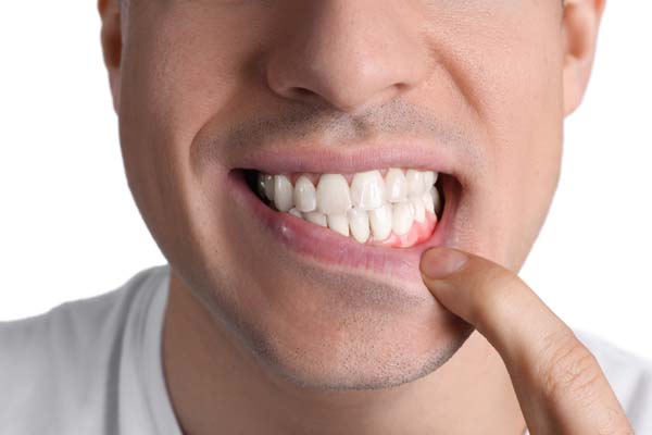 How Can I Prevent Gum Disease?